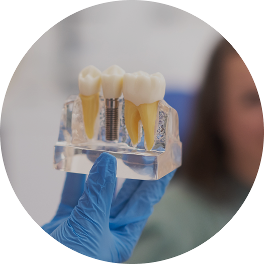 Imagem de um modelo de demonstração com um implante e prótese