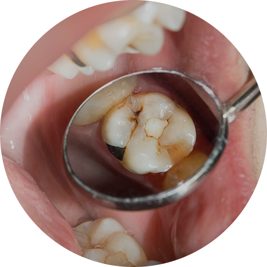 Imagem de um dente sendo olhado pelo espelho intraoral