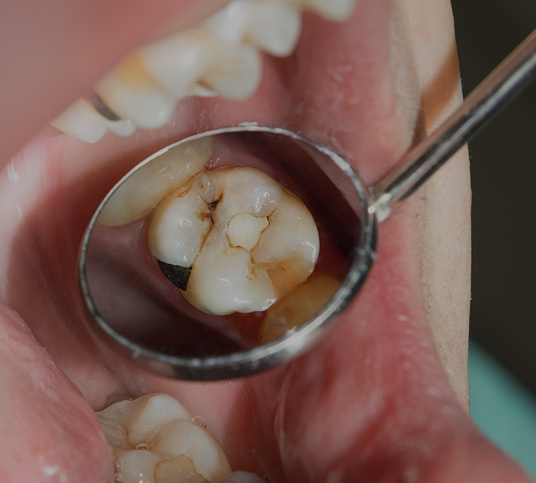 Imagem de um dente sendo olhado pelo espelo intraoral